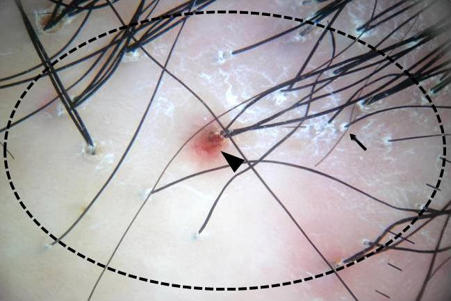 1). Broken hairs were observed in all of the 24 patients with TM. Broken hairs showed characteristic split ends (Fig. 2).