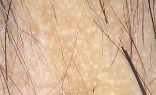 3 mm dots distributed regularly in the interfollicular scalp, dispersed among