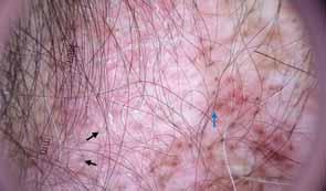 Chapter 4: Follicular and Perifollicular Patterns 61 Typically seen in DLE in the black where the hypopigmented scalp is present.