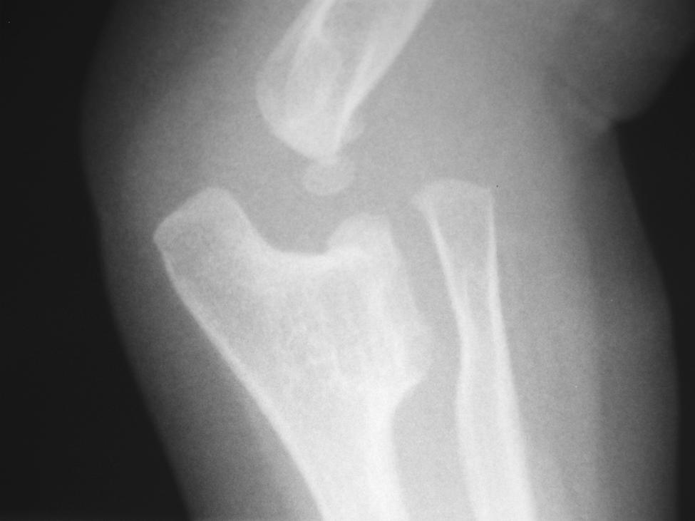 39 In rare cases, the injury occurs after the development of an osteochondroma in the proximal ulna, which leads to dislocation of the radial head as a result of local compression, such as in the