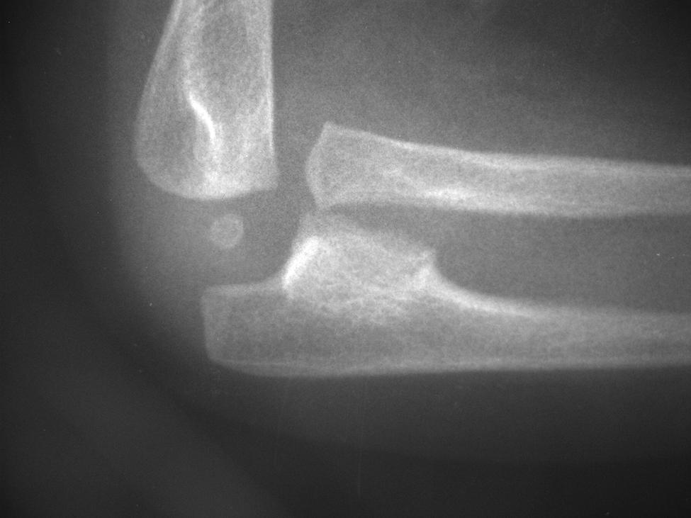Its occurrence as a result of pressure by an osteochondroma has only been described in the literature once in children, the case of a nine-year-old boy.