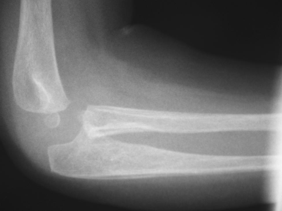Again, no relapse of the osteochondroma, the deformity, or radioulnar synostosis, had occurred.
