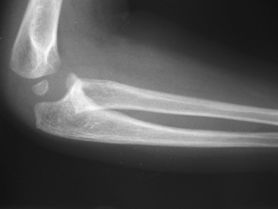 He was treated by means of an ulnar osteotomy and resection of the osteochondroma.