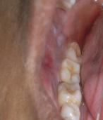 Fig 2 : Intra Oral photograph showing