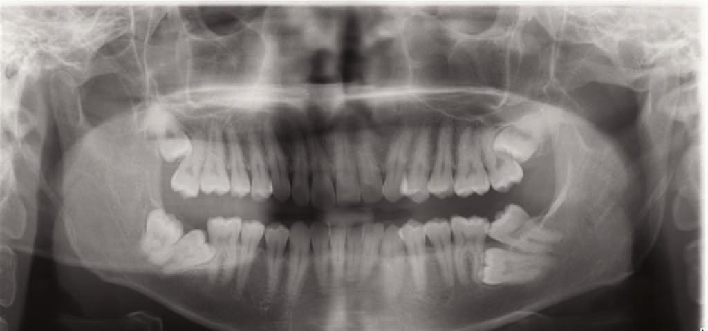 Case Report Simple Mechanics to Upright Horizontally Impacted Molars with Ramus Screws Dr Shih-Yung Lin, 1 Dr Chris Chang, 2 W.