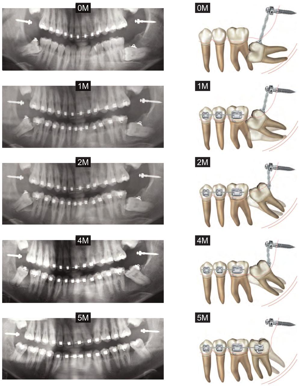 Figure 5: On the left, a series of panoramic films document tooth positions immediately after surgery (0m), then at 1