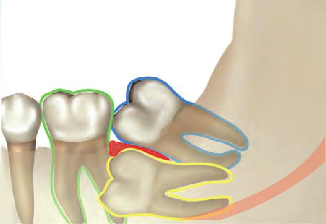 b. Thick cortical bone blocking the eruption of the second molar c. Ankylosis of the second molar, and/or d.