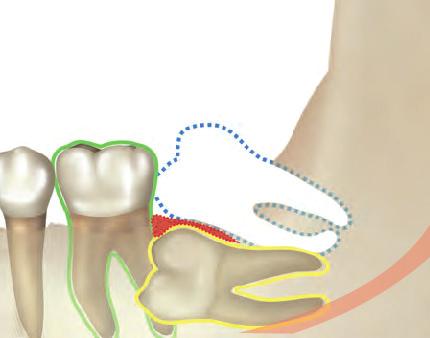 For predictable uprighting and alignment of the second molars, all of the potential etiologic factors were addressed by extracting the third molars and gently luxating the second molars (Figure 7).