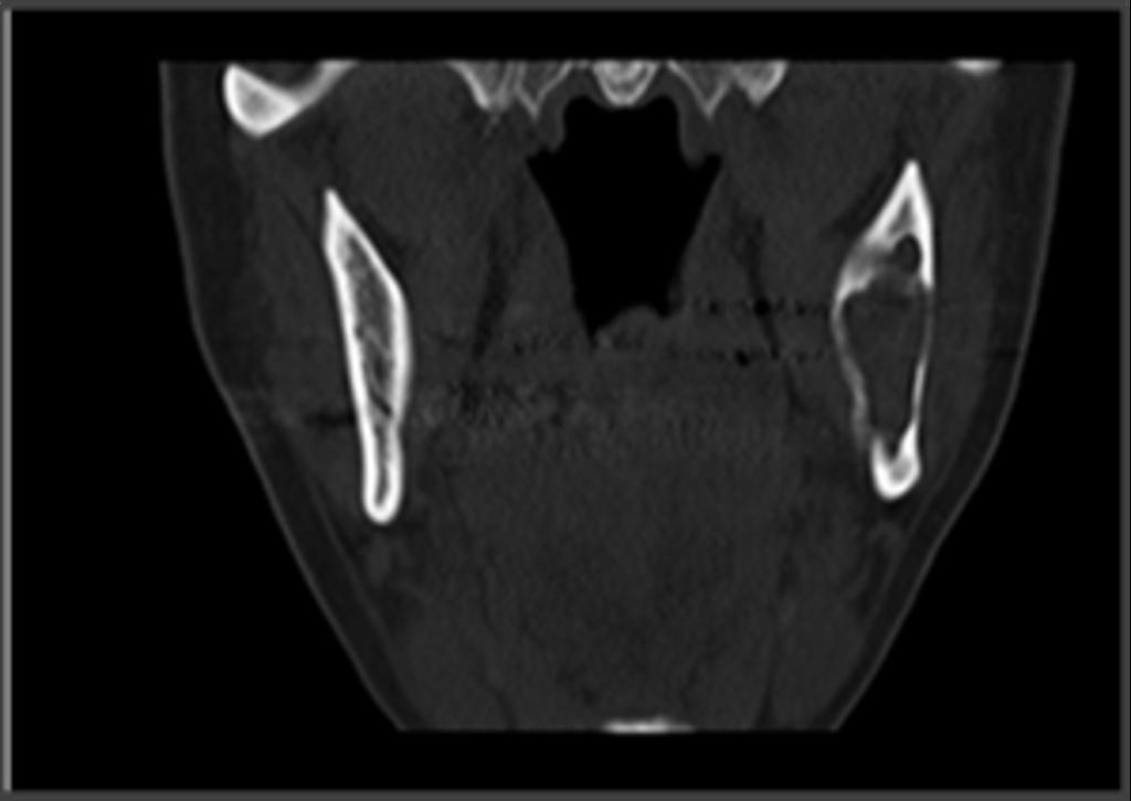 Fig. 3: Coronal reconstruction of bone CT shows that KOT tends to