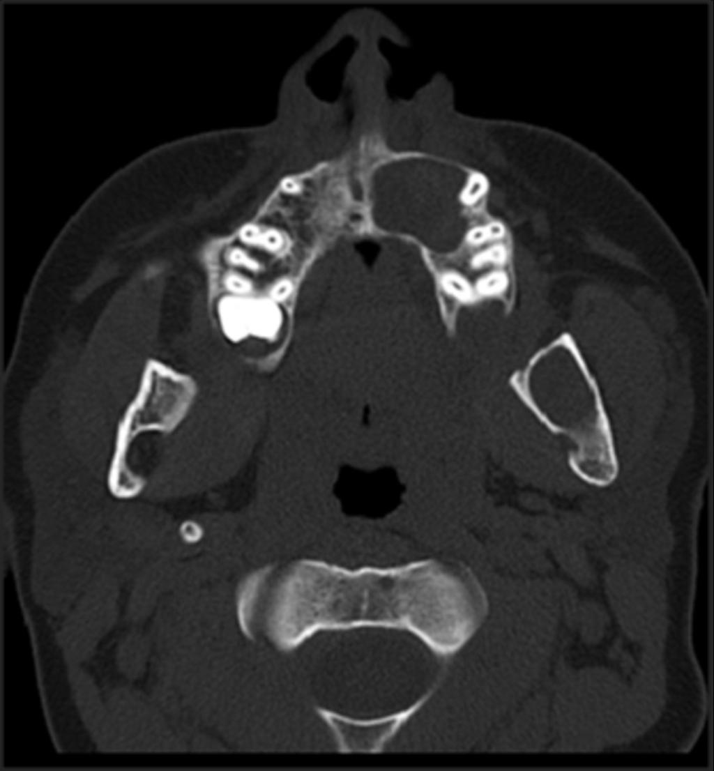Fig. 5: Axial bone CT of mandible:expansile cystic lesion with marked thinning cortex at buccal aspect. Fig.
