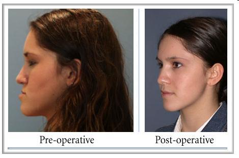 Correction of Dentofacial Deformities (Orthognathic Surgery) BDS, MSc, German board of Oral and Maxillofacial Surgery ( Berlin-Germany), Doctoral degree by LBMS Definition Orthognathic surgery is a