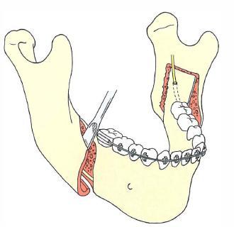 Surgical techniques for correction of mandibular prognathism 1) Bilateral sagittal split osteotomy (BSSO) 2) Vertical ramus osteotomy 3) Body osteotomy 4) Anterior mandibular subapical osteotomy.