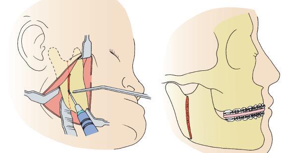 2-Vertical ramus osteotomy In this