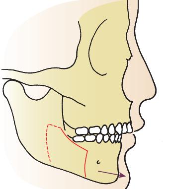 Bilateral sagittal split osteotomy with advancement of mandible.