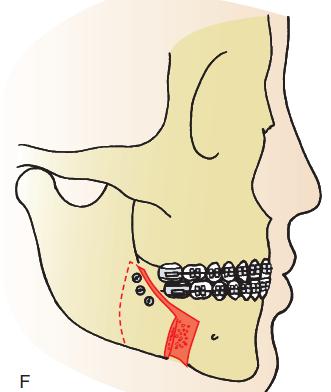 antero-posterior position of the chin is adequate but a class II malocclusion