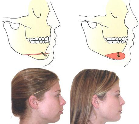 4- Inferior border osteotomy (Genioplasty): When a proper occlusal