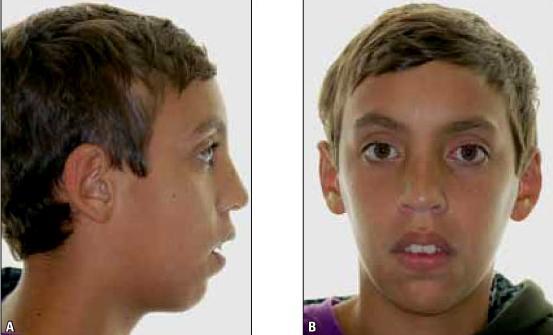 Maxillary excess (maxillary protrusion) Vertical, transverse and anteroposterior Clinical features: Elongation of the lower third of the face