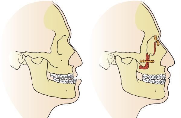 zygomatic projection, position of the nasal root, fronto-nasal angle, and