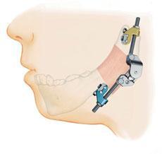 Distraction Osteogenesis Distraction osteogenesis (DO), also called callus distraction, callotasis and osteodistraction It is the process of generating new bone in a gap, created by osteotomy,