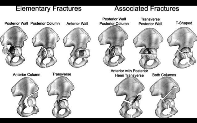 classification. The pelvis has been designated number 6 and acetabulum is number 2, thus acetabular fractures are designated by number 62.