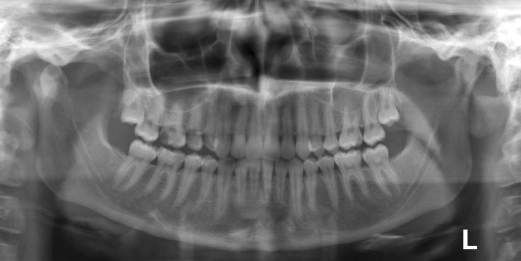 Case 9: Double fracture of the mandible Imaging: Panoramic X-ray Description (Level-2): Double fracture of the mandible - Condylar process fracture with displaced fragment of the condylar head on the