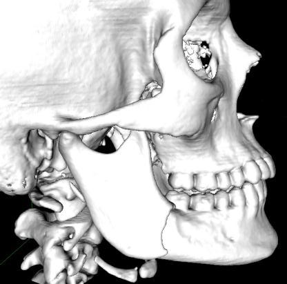 Case 10: Double fracture Imaging: 3D