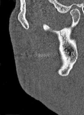 sagittal CT slices at the level of the right
