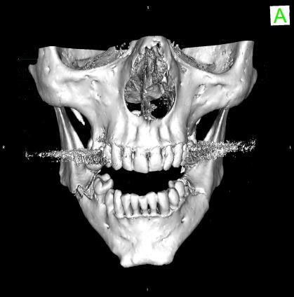Fracture line from the (sigmoid) mandibular