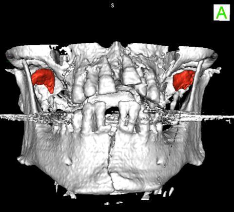 Case 14: Triple mandibular fracture (3) Imaging: 3
