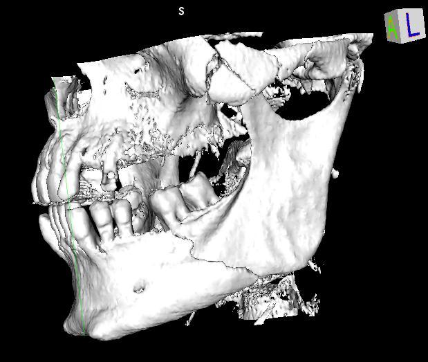 Case 16: Mandibular fracture within