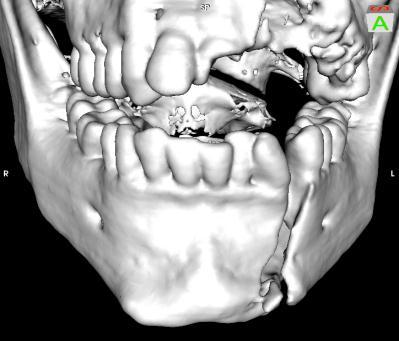Case 18: Mandibular body