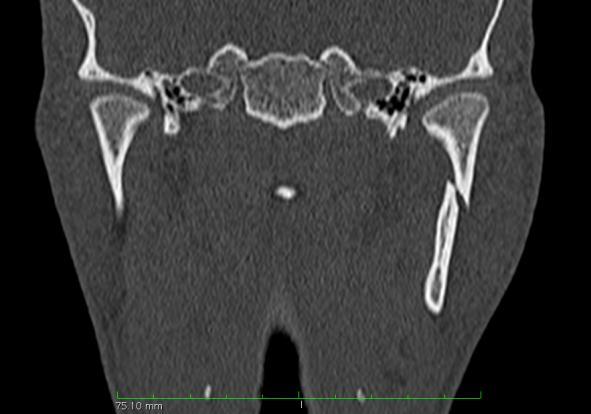 Case 8: Condylar process fracture Imaging: CT