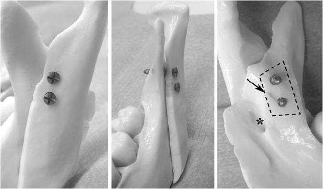 720 A Textbook of Advanced Oral and Maxillofacial Surgery (a) (b) (c) Figure 1. (a) Rigid fixation of intraoral vertico-sagittal ramus osteotomy using a mandibular model.