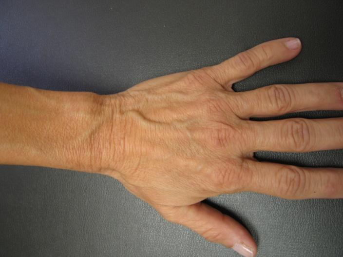 Superficial veins are those closer to the surface of the body, and have no corresponding arteries.