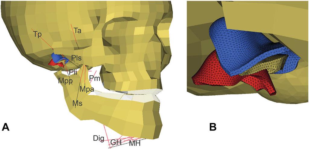 Biomechanical analysis of fractures in the mandibular neck (collum mandibulae) deactivated with a simultaneous activation of the jaw-closing muscles.