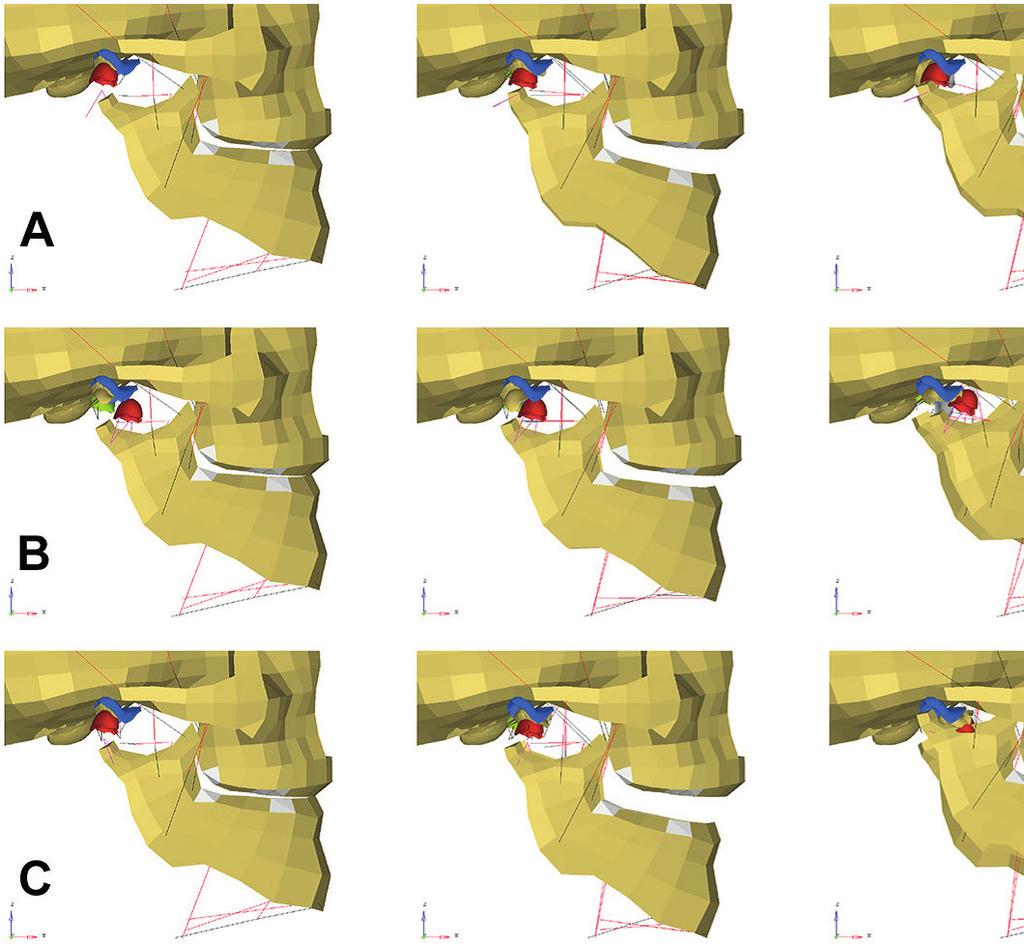Chapter 5 66 Figure 9. Predicted positions of the mandible after a fractured mandibular neck. A: mandibular neck replaced by compliant restraints.