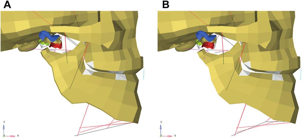 Predicted eff ect of activity of the lateral pterygoid muscle during maxillo-mandibular fi xation (cyan lines). A: sagittal view of the normal situation.