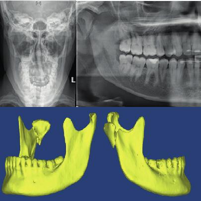 Chapter 6 was randomly divided in two groups. One group receiving the 2D imaging and the other group receiving the 3D imaging of the mandibular condyle fracture cases. 80 Figure 11.
