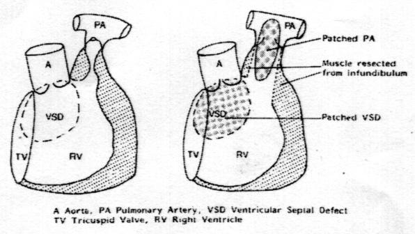 In the long term, the main problems are ventricular arrhythmias, right ventricular volume loading due to pulmonary incompetence and the need to change the valve conduit as the child grows.