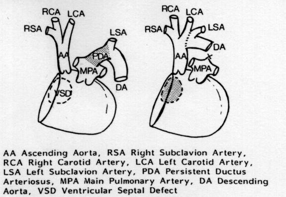 Fig 6 Anatomic correction of transposition of the great arteries.