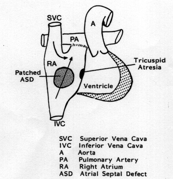 ventricular septal defect or with more complex problems. Generally when coarctation is associated with other lesions it presents in infancy with heart failure.