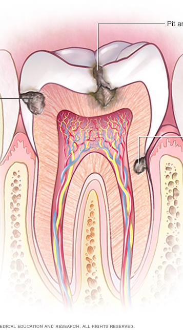 Dental Caries Cavities or tooth decay Breakdown of tooth structure (enamel and dentin) caused by the