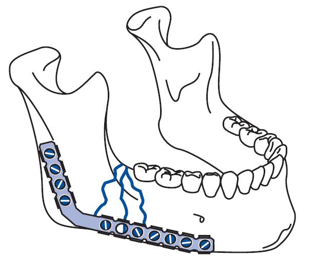 RIGID Load-Bearing Fixation Mandibular reconstruction bone plate Required in: Comminuted fractures of the mandible Fractures where