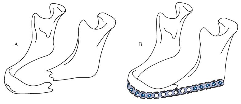 Atrophic mandibular fracture In the atrophic mandible a