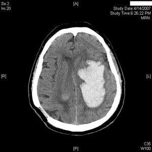 <4.5 hr IV Alteplase Neurosurgery if: Hydrocephalus Posterior fossa <6
