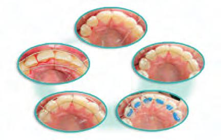 A Method for Stabilizing a Lingual Fixed Retainer in Place Prior to Bonding Abstract Aim: The objective of this article is to present a simple technique for stabilizing a lingual fixed retainer wire