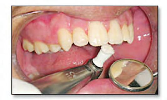 A simple chair side technique of fabricating and stabilizing a lingual retainer before bonding utilizing the existence of a fixed orthodontic appliance before debonding was presented by the author in