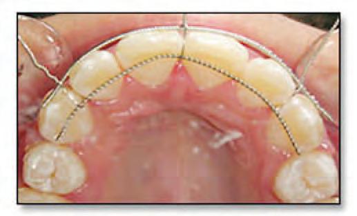 teeth, and the two are tied against each other using the three pieces of ligature wire which are inserted gingival to