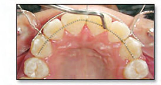 In cases with open contacts between the teeth, the anchor wire can be bonded to the labial surface of the teeth at