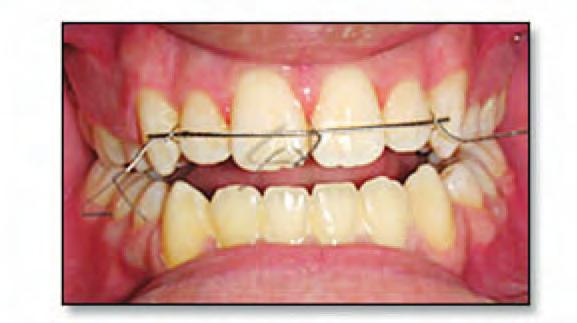 Adaptation and adjustment of the retainer wire in place using an amalgam condenser. 8.